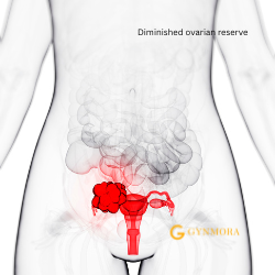 Diminished ovarian reserve (DOR)