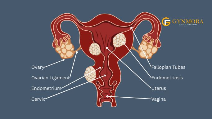 What Is the Endometrial Receptivity Array 2