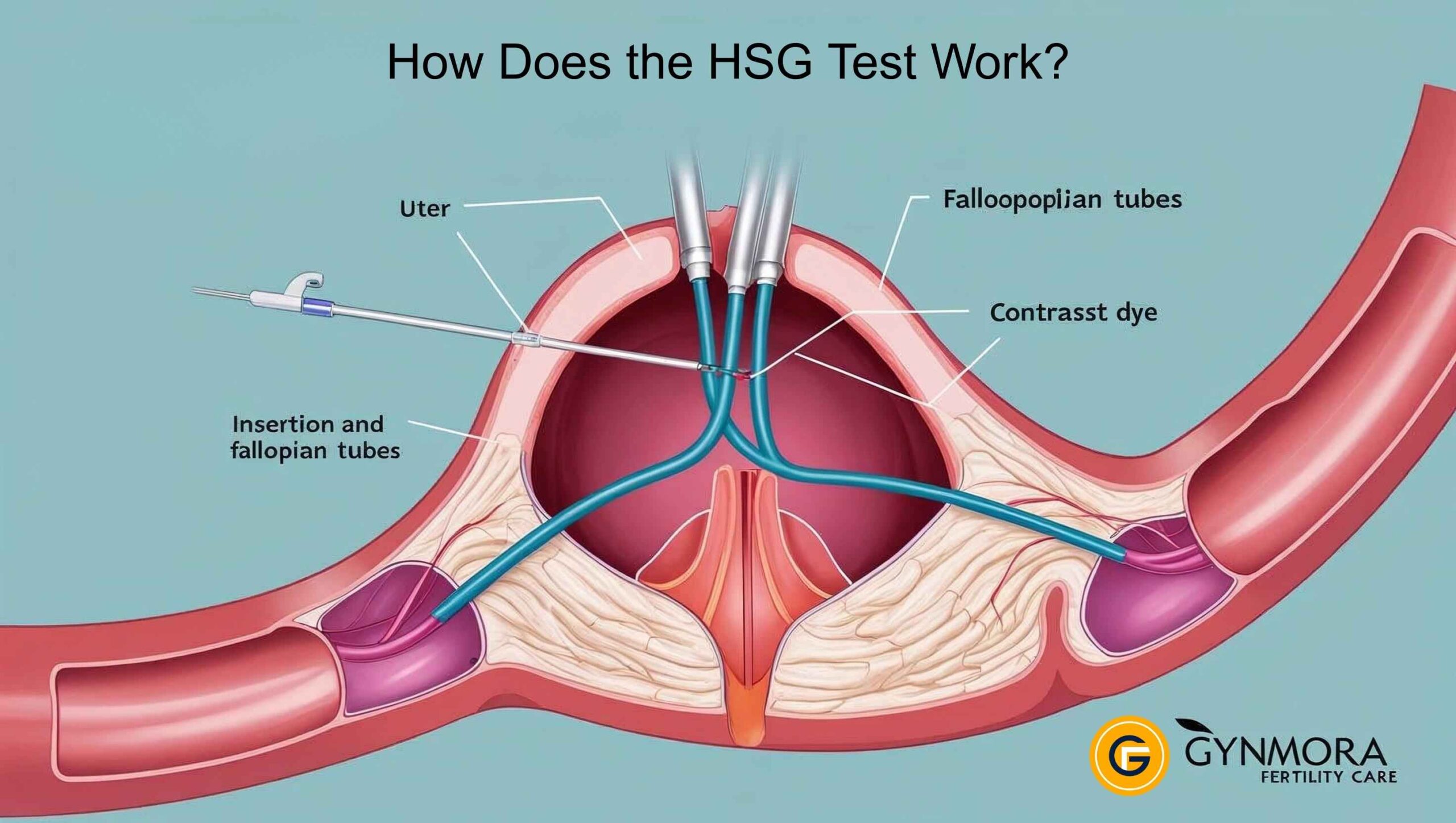 Hysterosalpingogram (HSG Fertility)